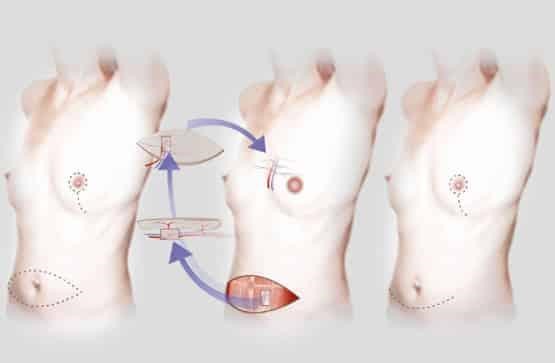 Autologous or Flap Reconstruction